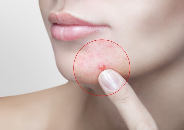 Lợi ích của tinh dầu thông đỏ Red Pine Hàn Quốc là giảm mụn nhọn, làm đẹp da