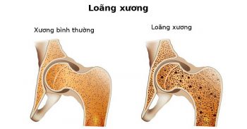 Sản phẩm giúp phòng ngừa loãng xương.